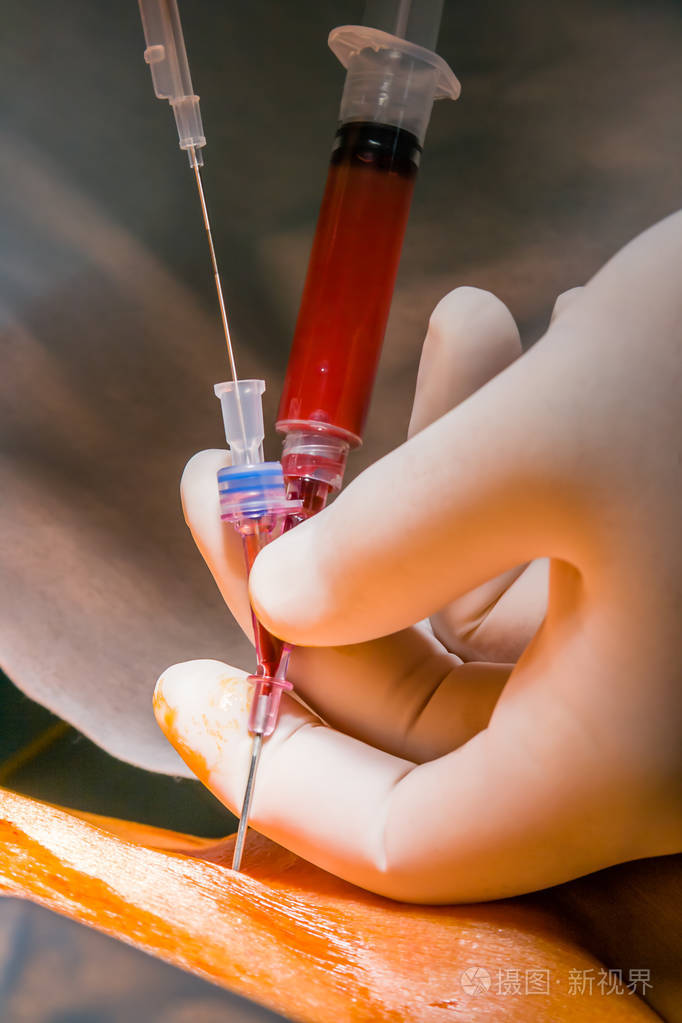 中心静脉穿刺置管