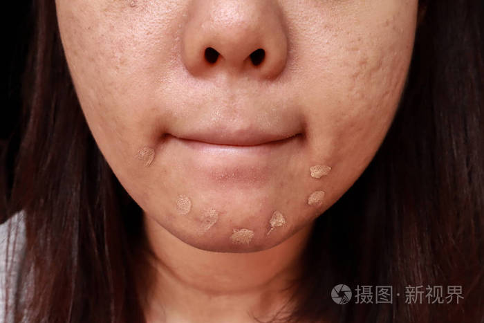 痤疮皮肤问题特写的亚洲妇女应用遮瑕膏