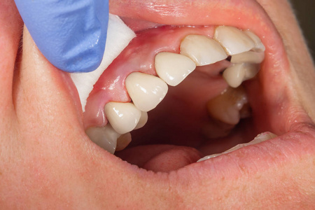 人牙烤瓷冠近距离显微隔离黑色烤瓷冠照片