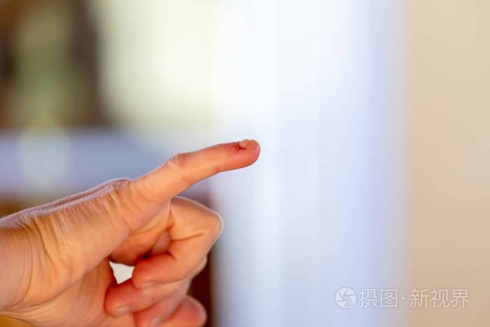 女人手上受伤的手指