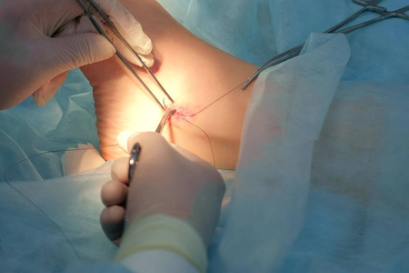 手术后,外科医生用自吸收线缝合腿部和脚踝的伤口.照片