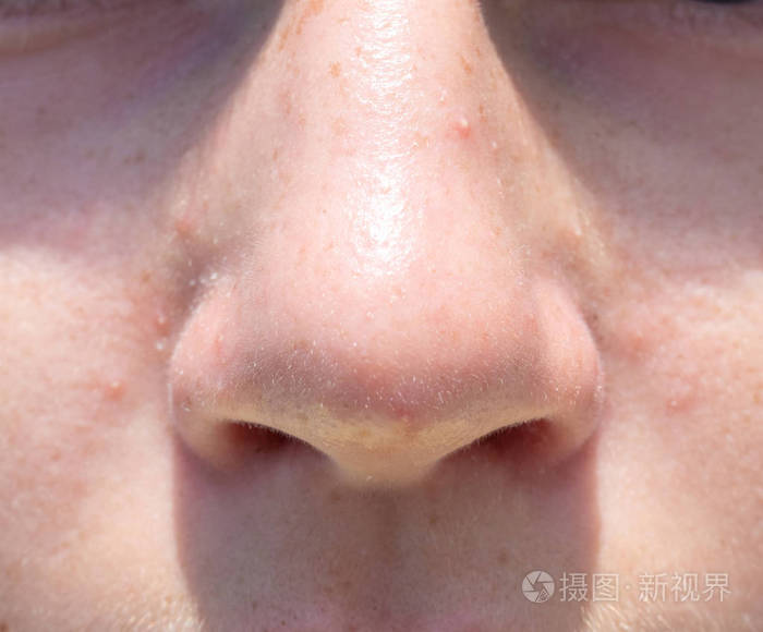 鼻子少女特写前视图痤疮照片-正版商用图片2okhf2-摄图新视界