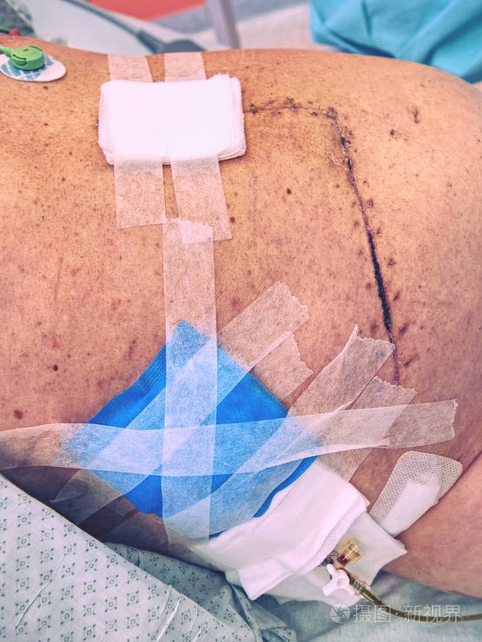 肝脏手术后的医学疤痕肿瘤切除肿瘤学癌症