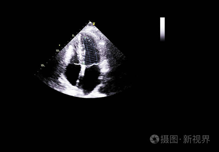 超声心动图超声机屏幕。