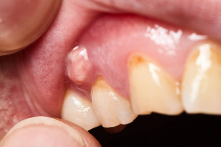 牙龈炎症脓肿特写图片