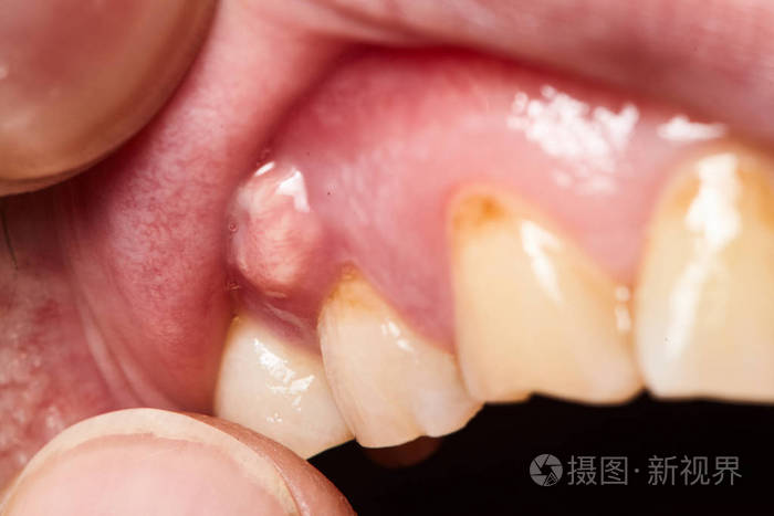 牙龈炎症脓肿特写