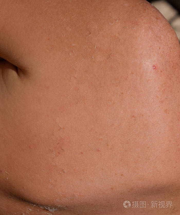 背部皮肤晒伤去角质皮肤脱落危险的晒黑