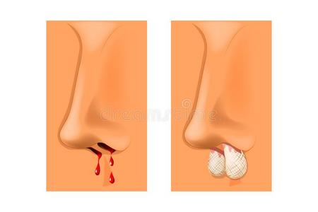 鼻子流血图片-鼻子流血素材-鼻子流血插画-摄图新视界