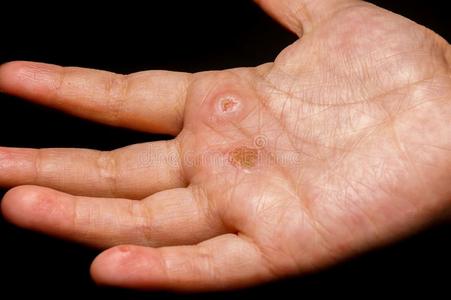 小孩湿疹手手掌照片
