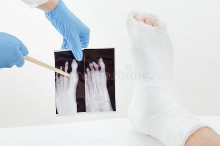 医生仔细检查字母x射线影像,破碎的腿关于指已提到的人有耐性的采用币膏剂