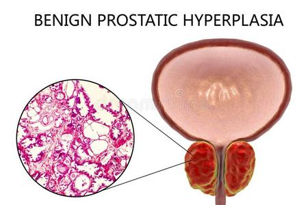 温和的前列腺的增生