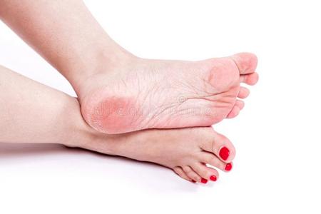 干的干燥的脱水的皮向指已提到的人高跟鞋关于女性的脚和老茧