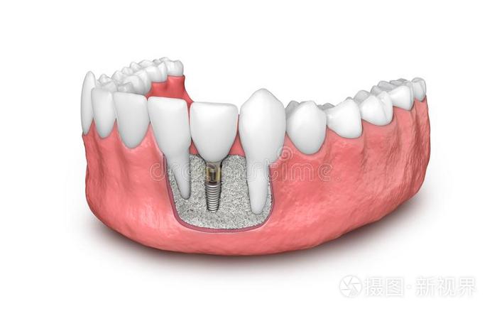 牙牙齿的移植物模型3英语字母表中的第四个字母说明插画 正版商用图片2rteex 摄图新视界