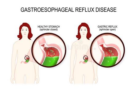 gastroesophagealrefluxdisease胃食道逆流性疾病照片