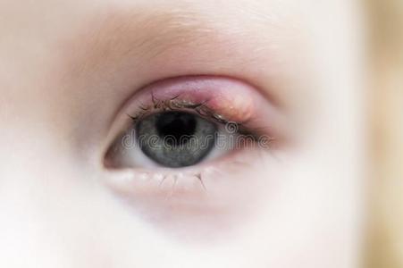 睑板腺囊肿图片