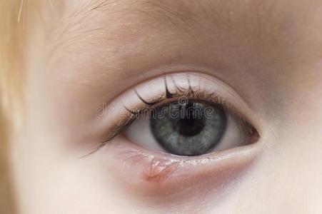 睑板腺囊肿图片