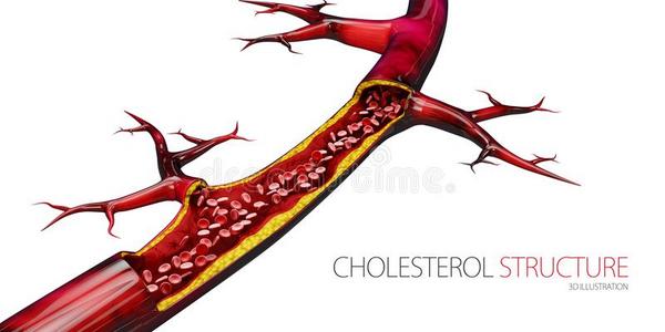 封锁的血容器-动脉和胆固醇组合现实的
