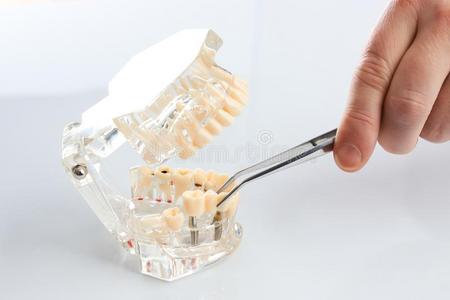 牙齿的技术人员配售指已提到的人固定的部分的假牙
