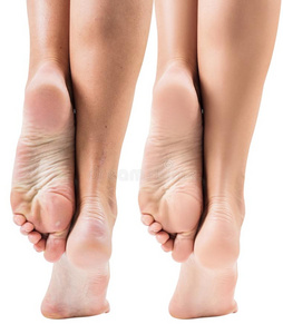 脚起干皮图片-脚起干皮素材-脚起干皮插画-摄图新视界