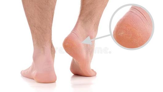 脚后跟骨刺图片