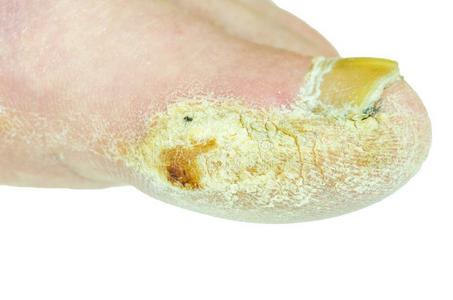 极端的坏的脚皮细菌的真菌的传染和被损坏的namibia纳米比亚照片