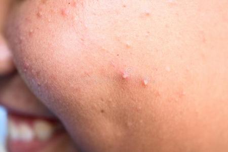皮肤病学的疾病痤疮丘疹向指已提到的人面容关于一青少年男孩照片