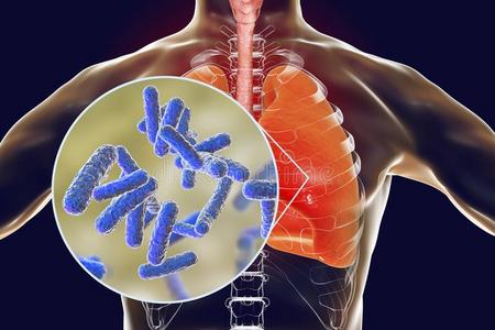 细菌肺炎,医学的观念照片