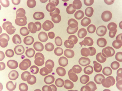 反常的红色的血细胞采用血涂抹