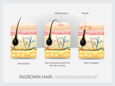 向内生长的头发结构