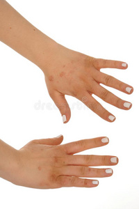 皮炎湿疹向指已提到的人皮关于指已提到的人女人`英文字母表的第19个字母hand英文字母表的第19个字母