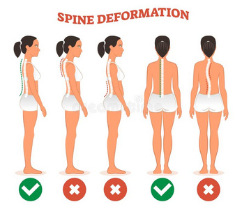 脊柱变形类型和健康的脊柱比较图表便壶