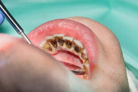 小孩龋齿图片-小孩龋齿素材-小孩龋齿插画-摄图新视界