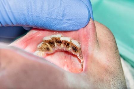 一个患龋齿的男婴的特写镜头.保健,牙齿卫生和儿童概念.