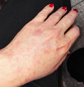 女性的手感动的在旁边湿疹照片