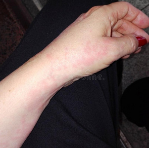 女性的手感动的在旁边湿疹照片