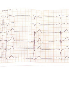 关在上面关于一心电图采用纸形状