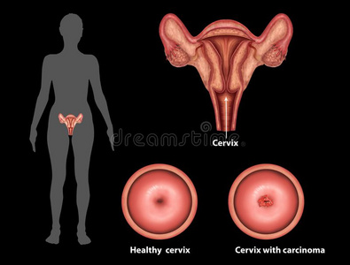 癌症的子宫子宫颈癌症照片