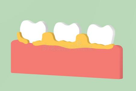 牙牙齿周围的疾病和牙齿的匾额或酒石