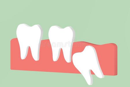 智慧牙有角的或中央的装紧影响向别的牙