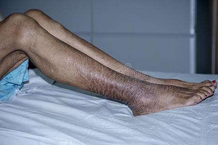 鱼鳞病图片 鱼鳞病素材 鱼鳞病插画 摄图新视界