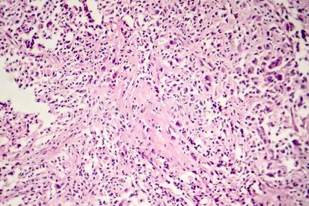 身体肉芽肿化脓性肉芽肿在眼试验红细胞背景上有毒性肉芽的中性粒细胞