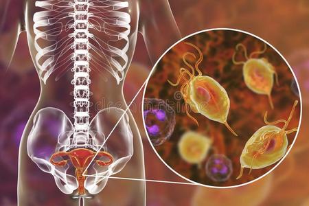 女性的滴虫病,说明展映滴虫阴道照片