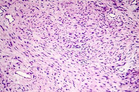 养老金或抚恤金的人女性的,皮肤的纤维瘤特写镜头皮加标签于或acroch