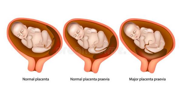 不同的胎盘位置在的时候怀孕胎儿在子宫内, 7 月, 胚胎发育阶段在白色