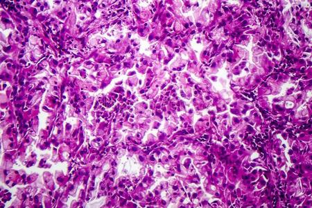 癌病理组织病理学说关于肺癌症照片