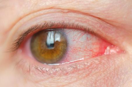 特写镜头恼怒的被感染的红色的充血的眼睛,结膜炎照片