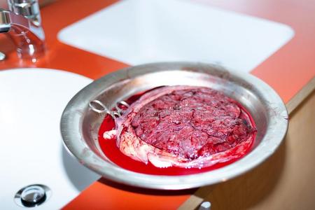 胞衣新生的人胎盘照片