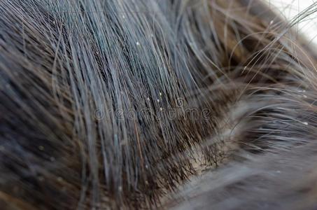 儿童皮肤病虱子鸡蛋照片