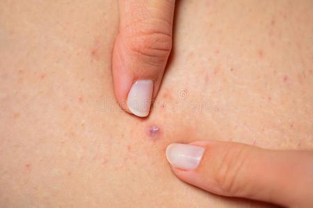 毛囊炎向女性的腿-挤压摄影图