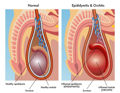 附睾炎图片